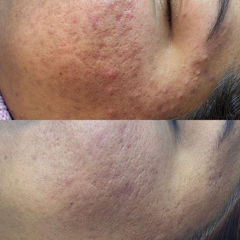 AfterGlow Peel Before & After Treatment