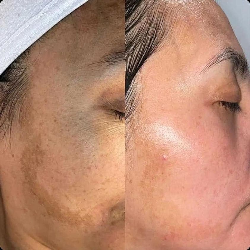 AfterGlow Peel Before & After Treatment
