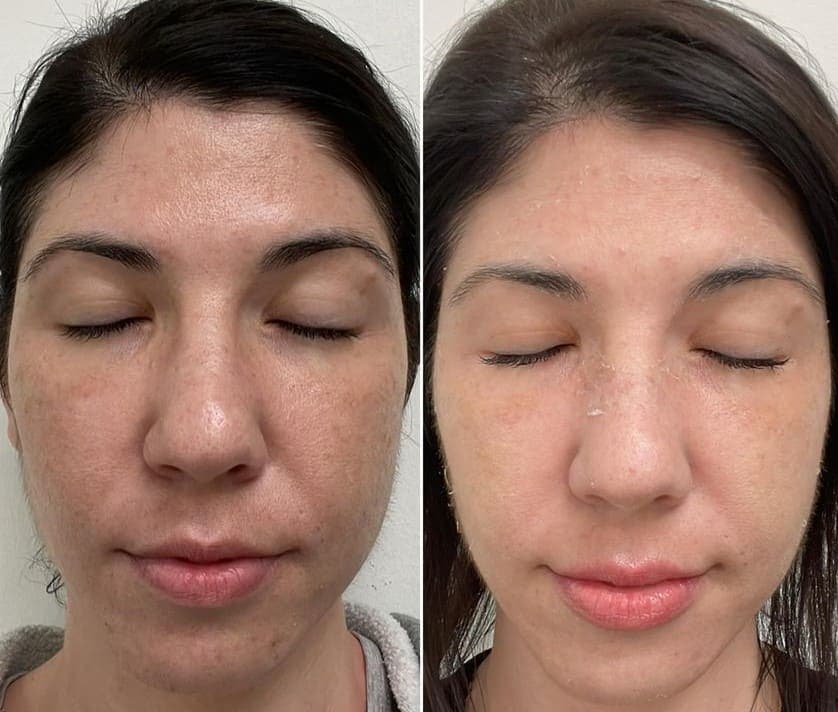 AfterGlow Peel Before & After Treatment