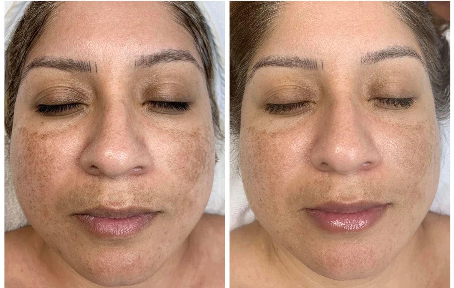 AfterGlow Peel Before & After Treatment