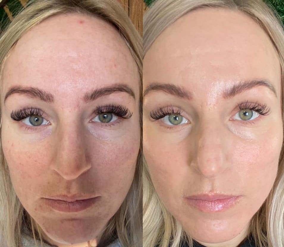 AfterGlow Peel Before & After Treatment