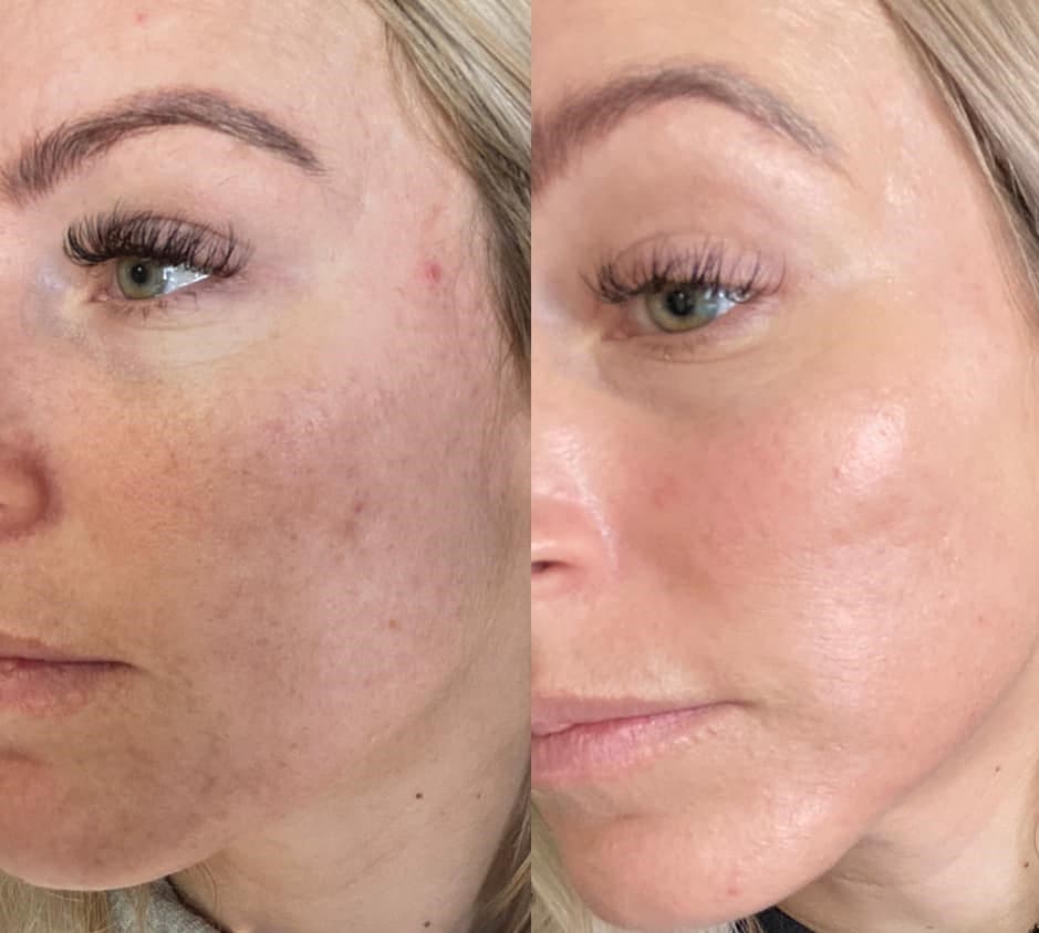 AfterGlow Peel Before & After Treatment