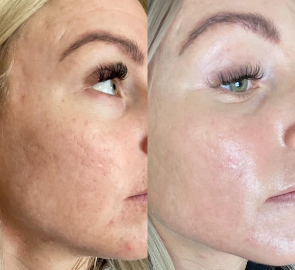 AfterGlow Peel Before & After Treatment