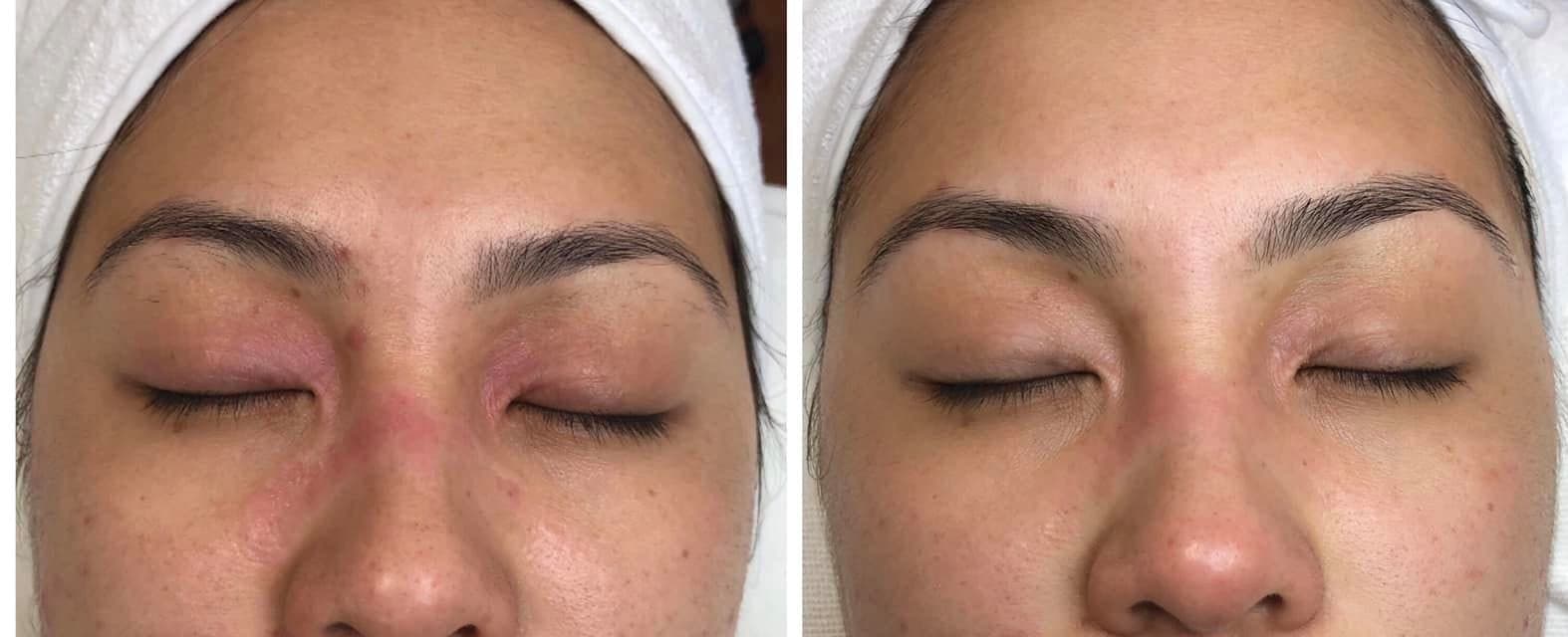 AfterGlow Peel Before & After Treatment