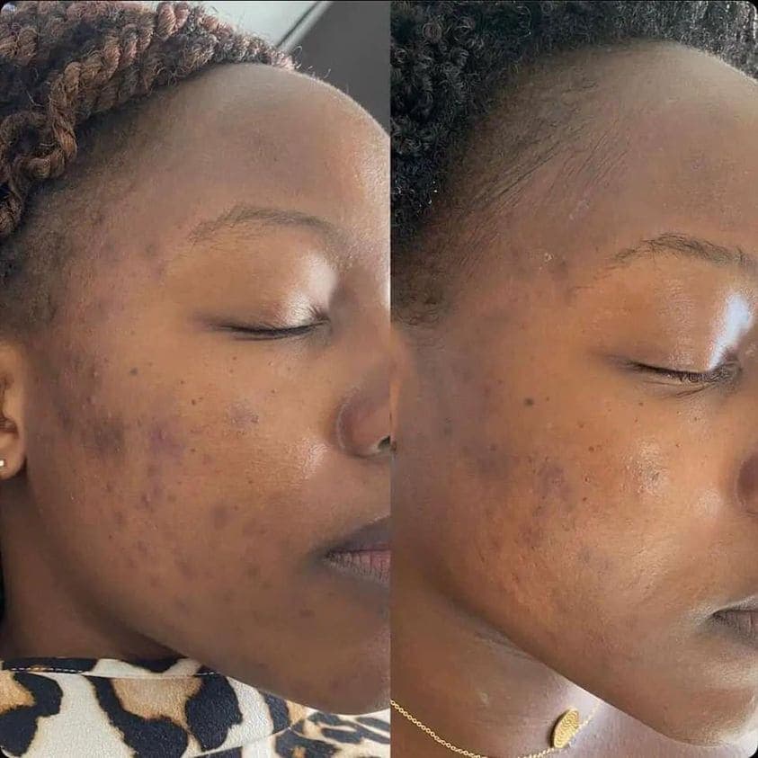 AfterGlow Peel Before & After Treatment