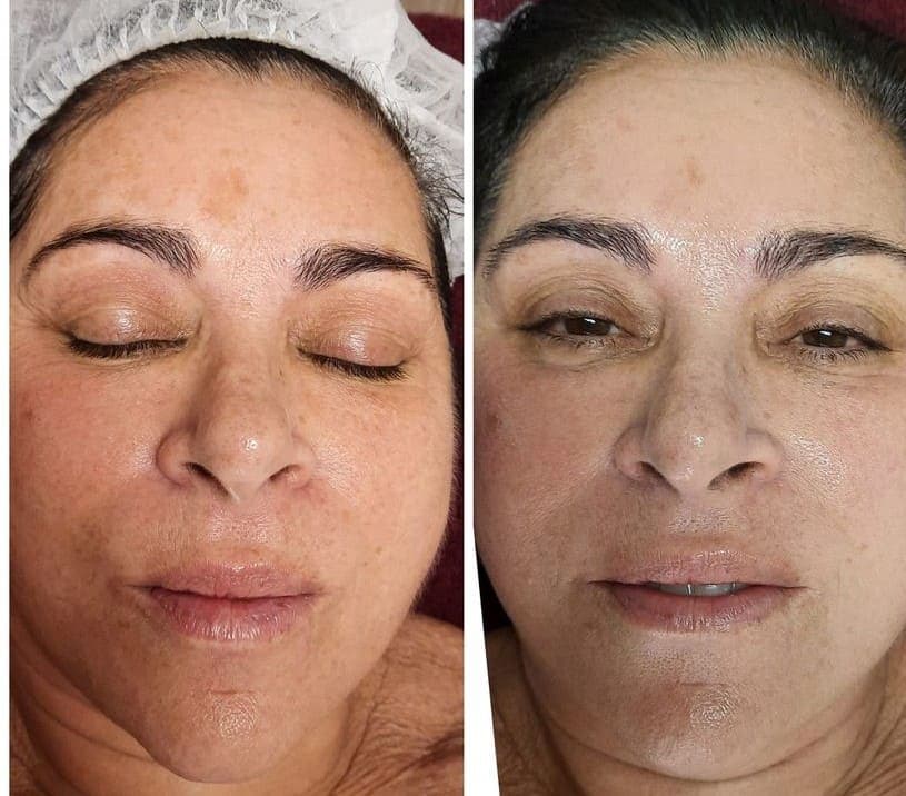 AfterGlow Peel Before & After Treatment