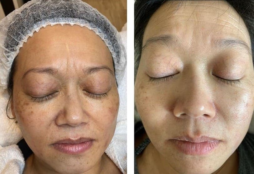 AfterGlow Peel Before & After Treatment