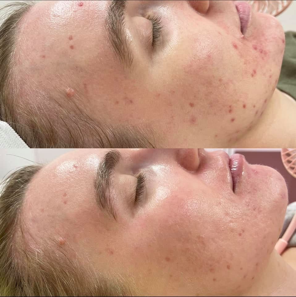 AfterGlow Peel Before & After Treatment