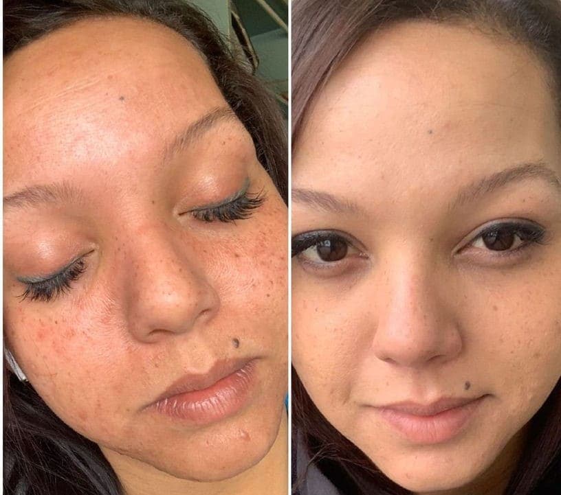 AfterGlow Peel Before & After Treatment