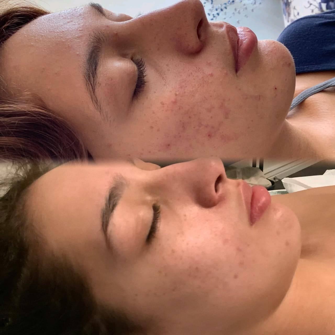 AfterGlow Peel Before & After Treatment