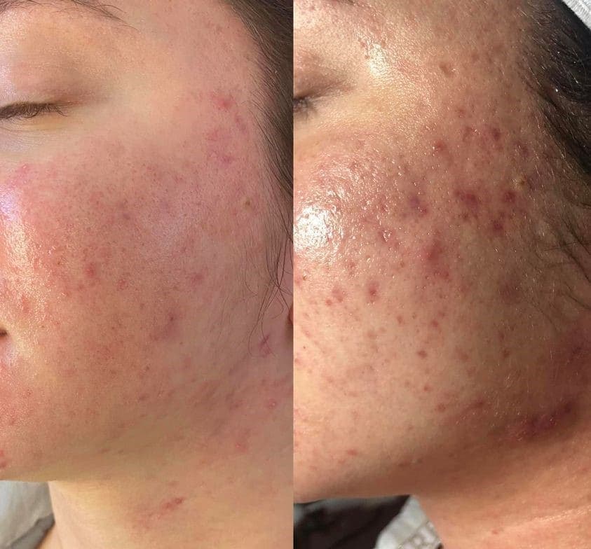 AfterGlow Peel Before & After Treatment