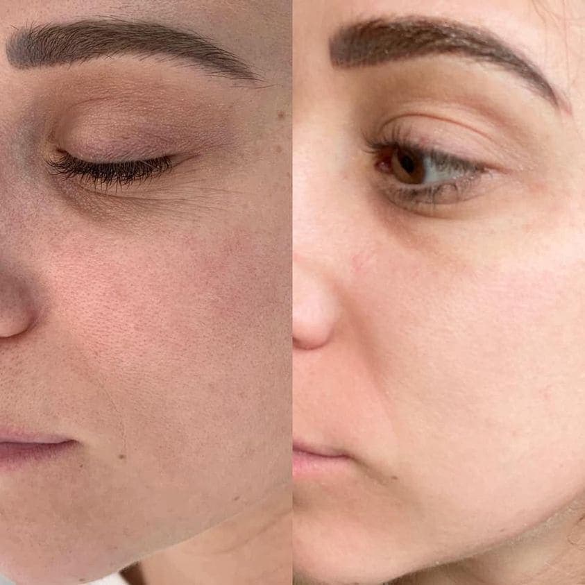 AfterGlow Peel Before & After Treatment