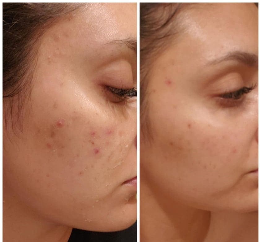 AfterGlow Peel Before & After Treatment