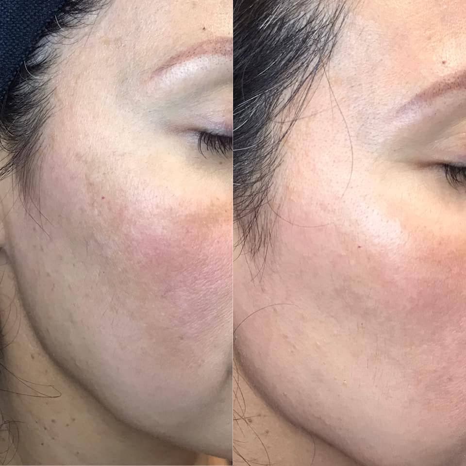 AfterGlow Peel Before & After Treatment