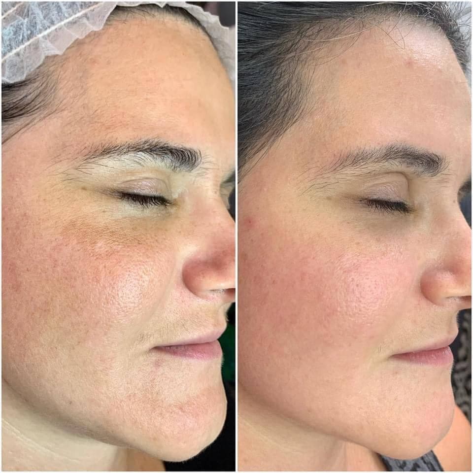 AfterGlow Peel Before & After Treatment