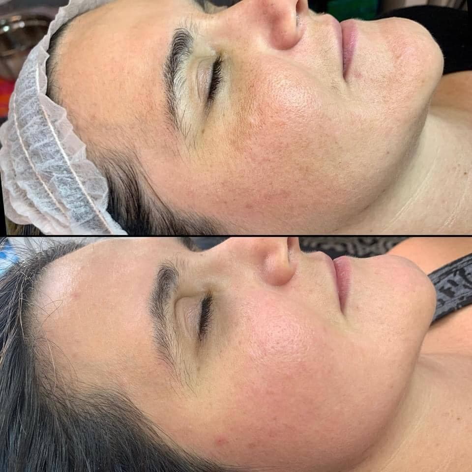 AfterGlow Peel Before & After Treatment