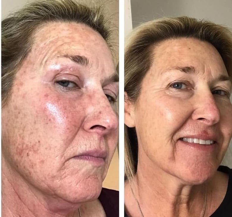 AfterGlow Peel Before & After Treatment