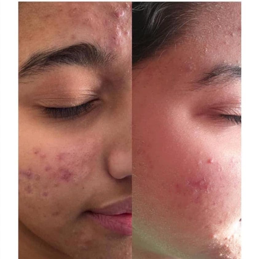 AfterGlow Peel Before & After Treatment