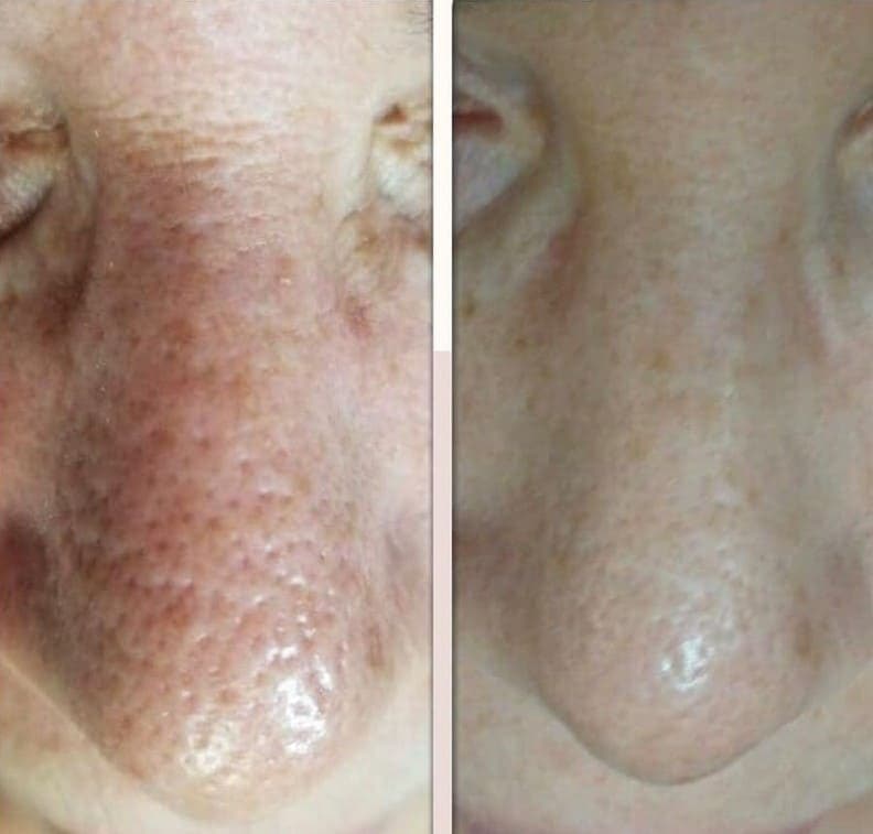 AfterGlow Peel Before & After Treatment