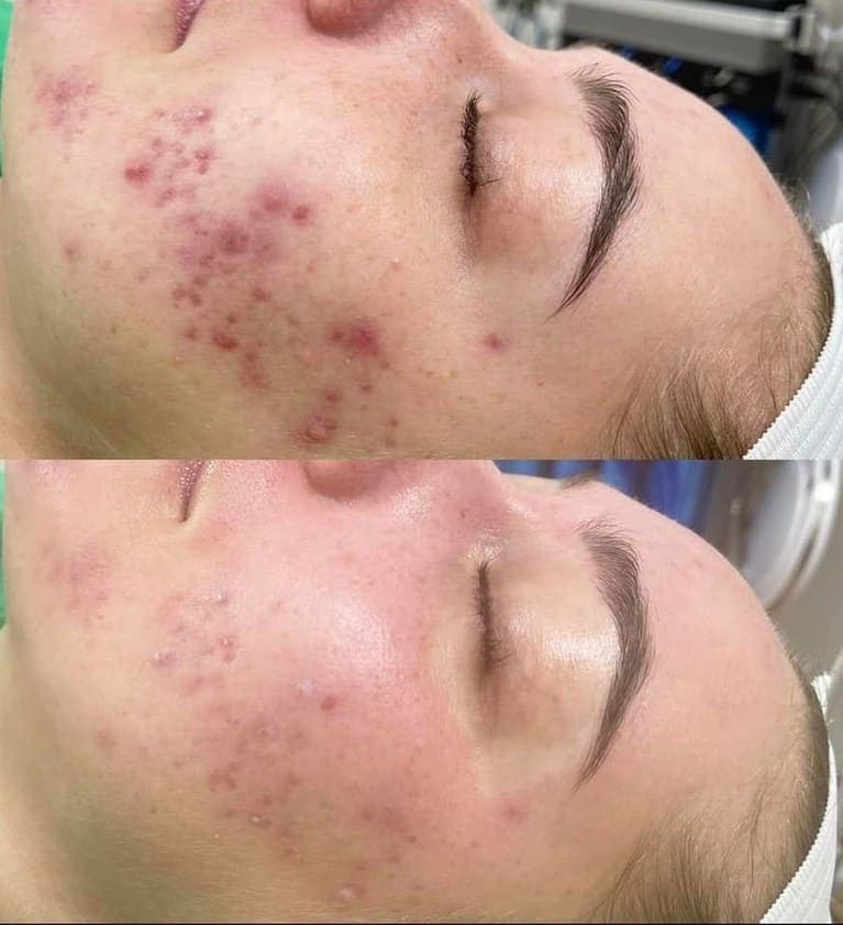 AfterGlow Peel Before & After Treatment