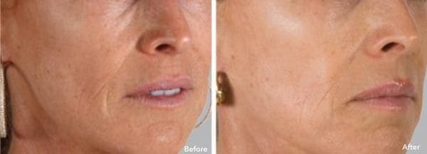 AnteAge Before & After Treatment