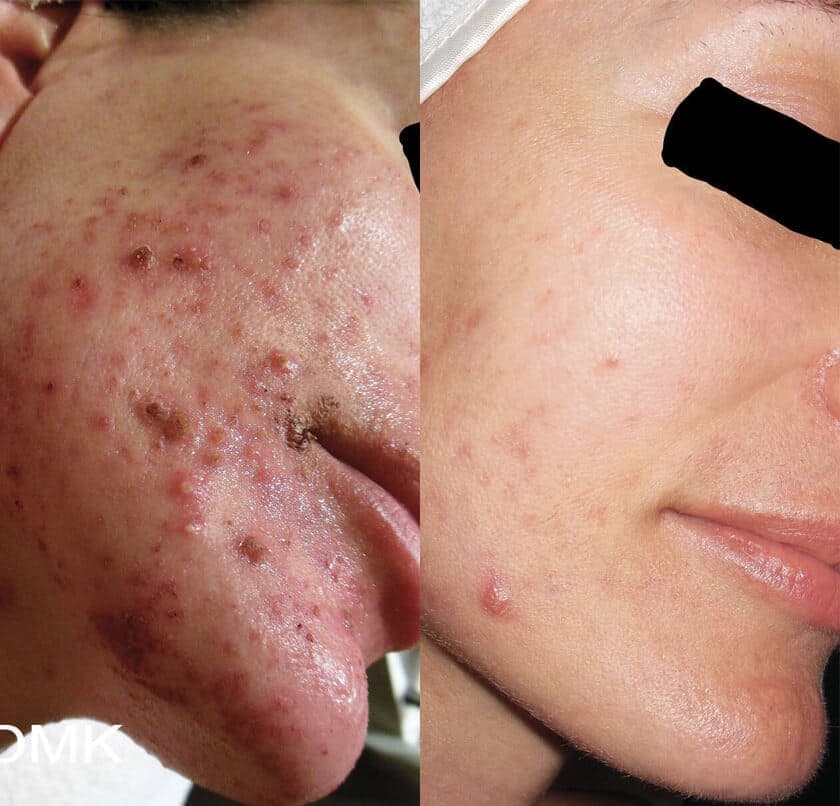 DMK Enzyme Therapy Before & After