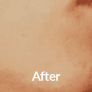 Essence of Beauty After Green Peel Treatment