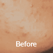 Essence of Beauty Before Green Peel Treatment