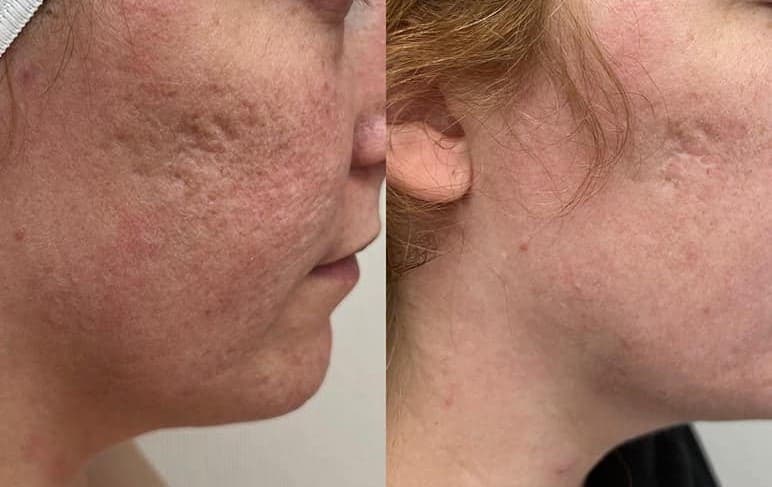 Microneedling Before & After Treatment at Essence of Beauty Ottawa