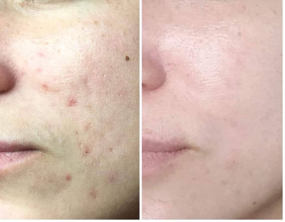 Microneedling Before & After Treatment at Essence of Beauty Ottawa