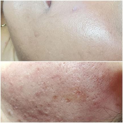 Bio Microneedling Before & After