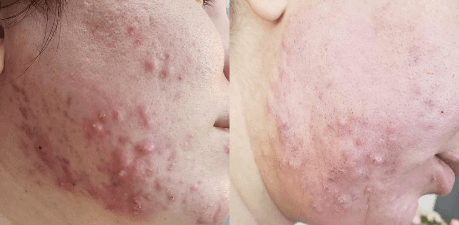 Bio Microneedling Before & After