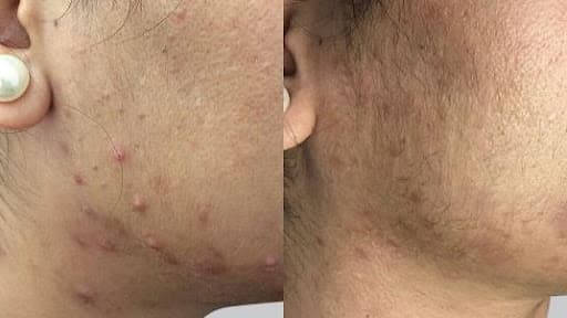 Bio Microneedling Before & After