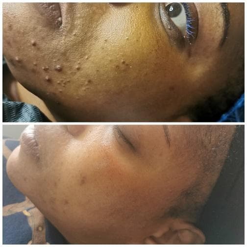 Bio Microneedling Before & After