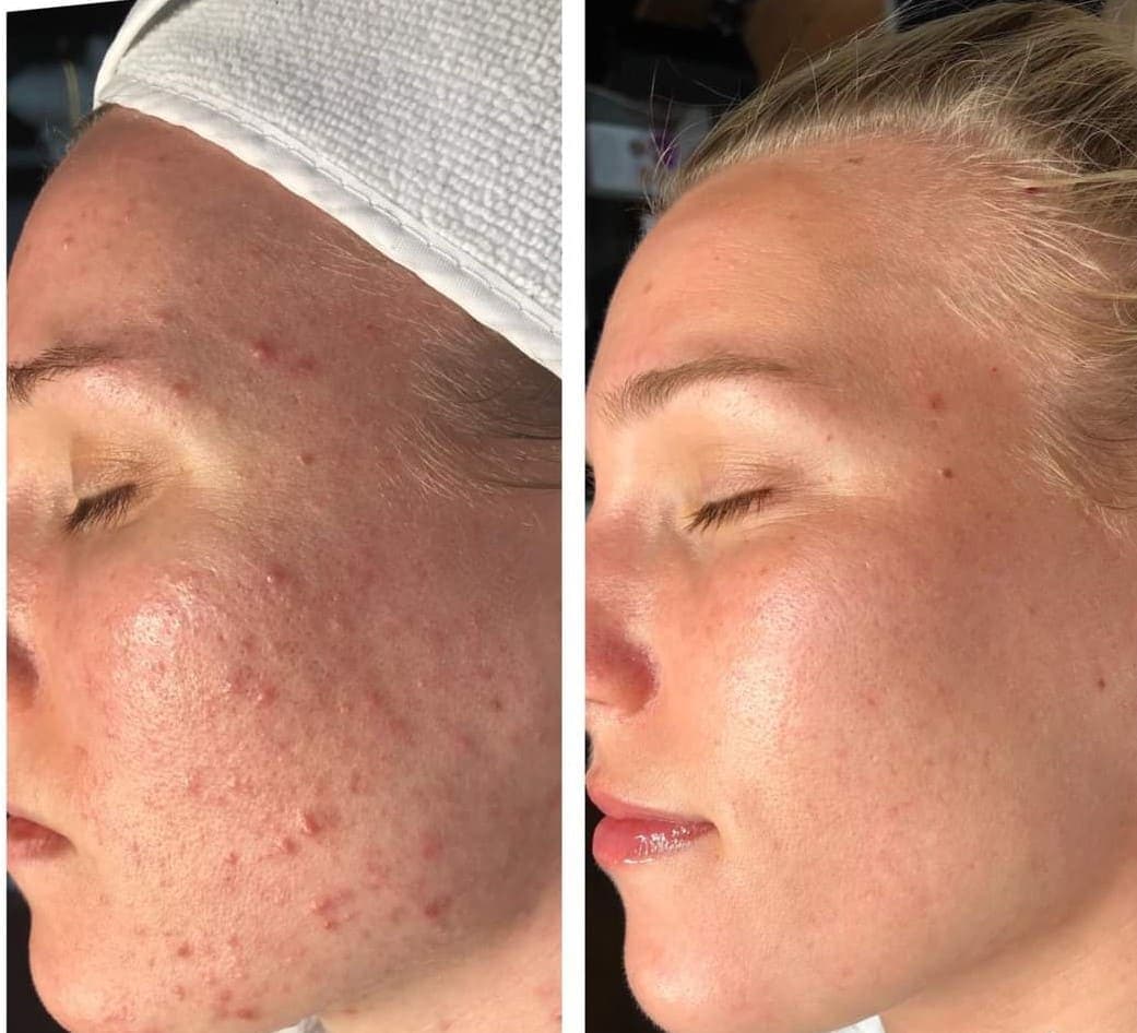 Essence of Beauty acne consultation