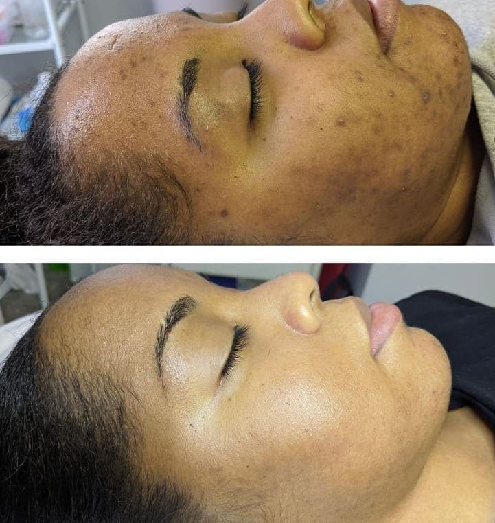 Essence of Beauty Ottawa AfterGlow Chemical Peel