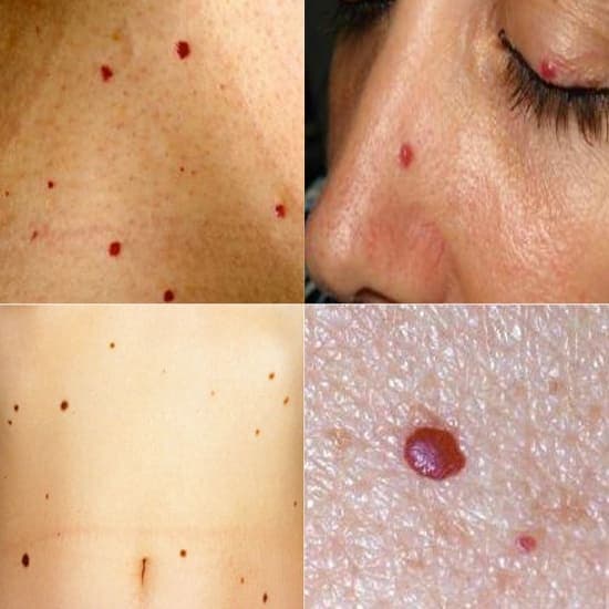 Cherry Angiomas