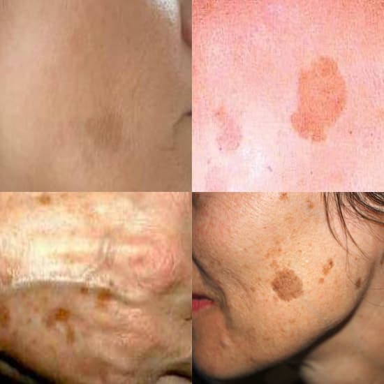 Flat Hyperpigmentation