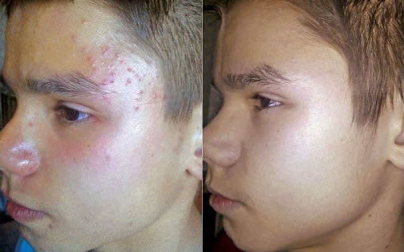 Acne correction skin treatment