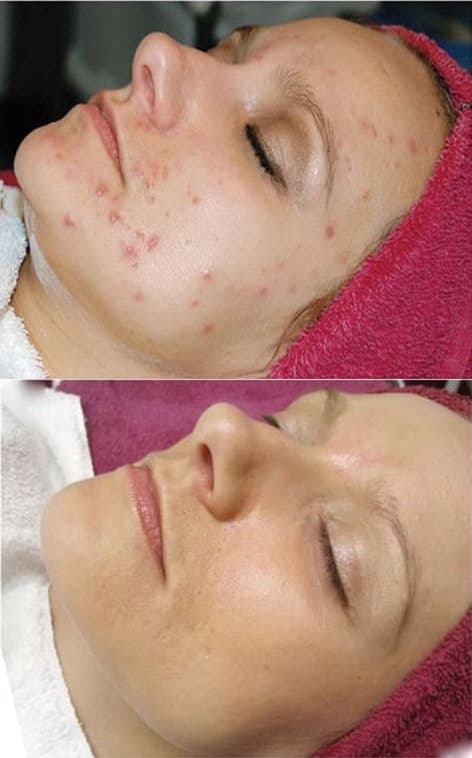 Acne correction results — before and after