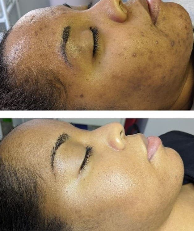 Hyperpigmentation & Melasma Treatment