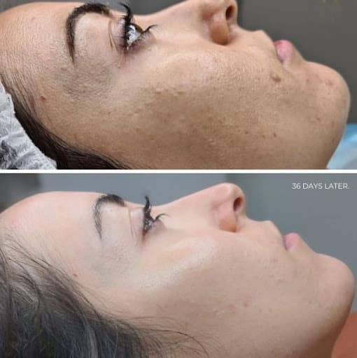 Essence of Beauty Ottawa Herbal Green Peel results — before and after