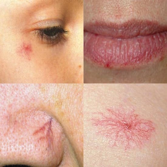 Telangiectasia & Spider Angiomas