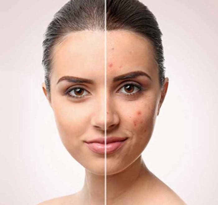 Essence of Beauty Acne Treatment