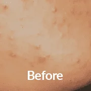 Essence of Beauty Before Green Peel Treatment