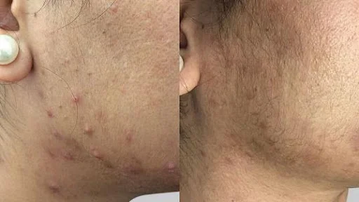 Bio Microneedling Before & After