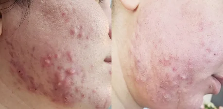 Bio Microneedling Before & After