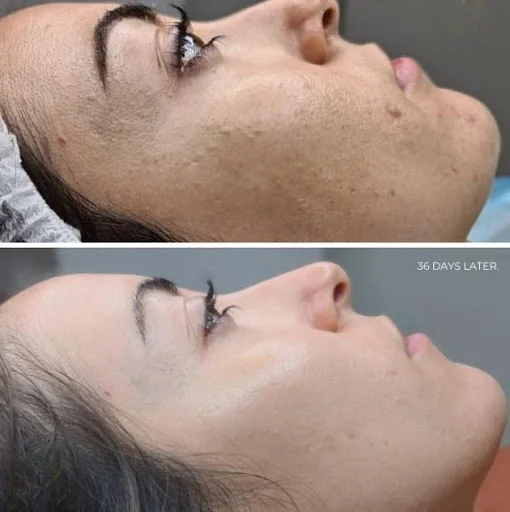 Essence of Beauty Bio Microneedling Treatment