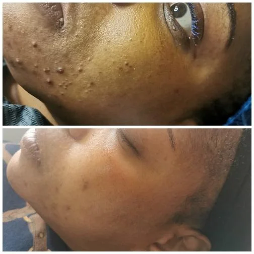 Bio Microneedling Before & After
