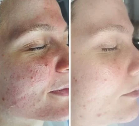 Before & After Acne Treatment